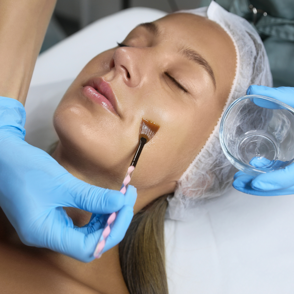 Chemical Peels